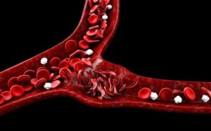 Серповидноклеточная анемия — заболевание крови