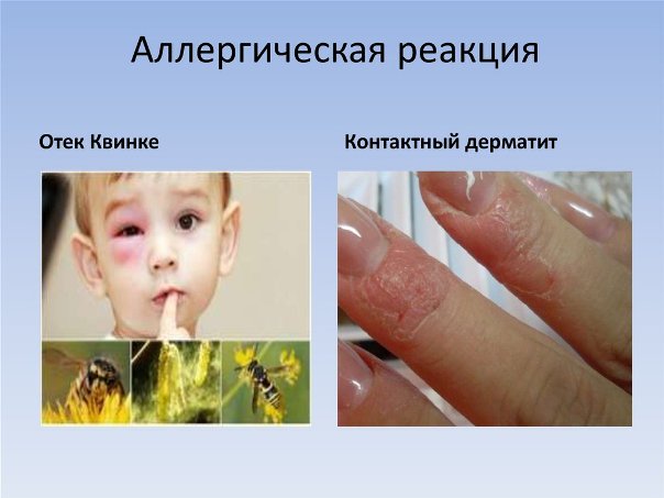 Аллергия. Причины возникновения и виды лечения