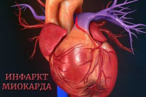 Сердечный приступ или инфаркт миокарда
