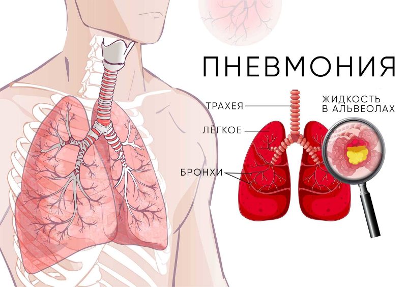 Пневмония. Симптомы, причины, диагностика и лечение