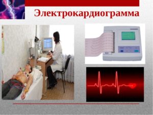 Заболевания сердца и электрокардиограммы (ЭКГ)