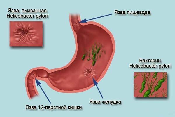 Язвы у человека. Какие причины появления?